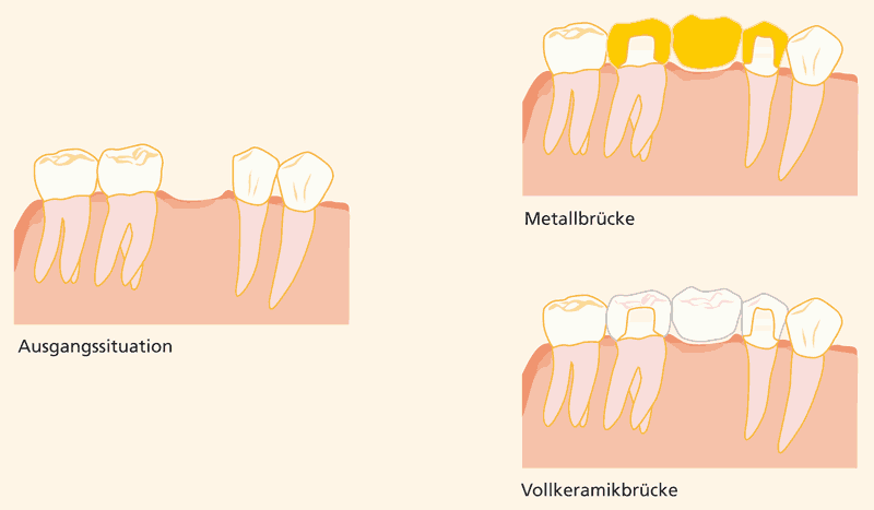 Erläuterungen zu Brücken